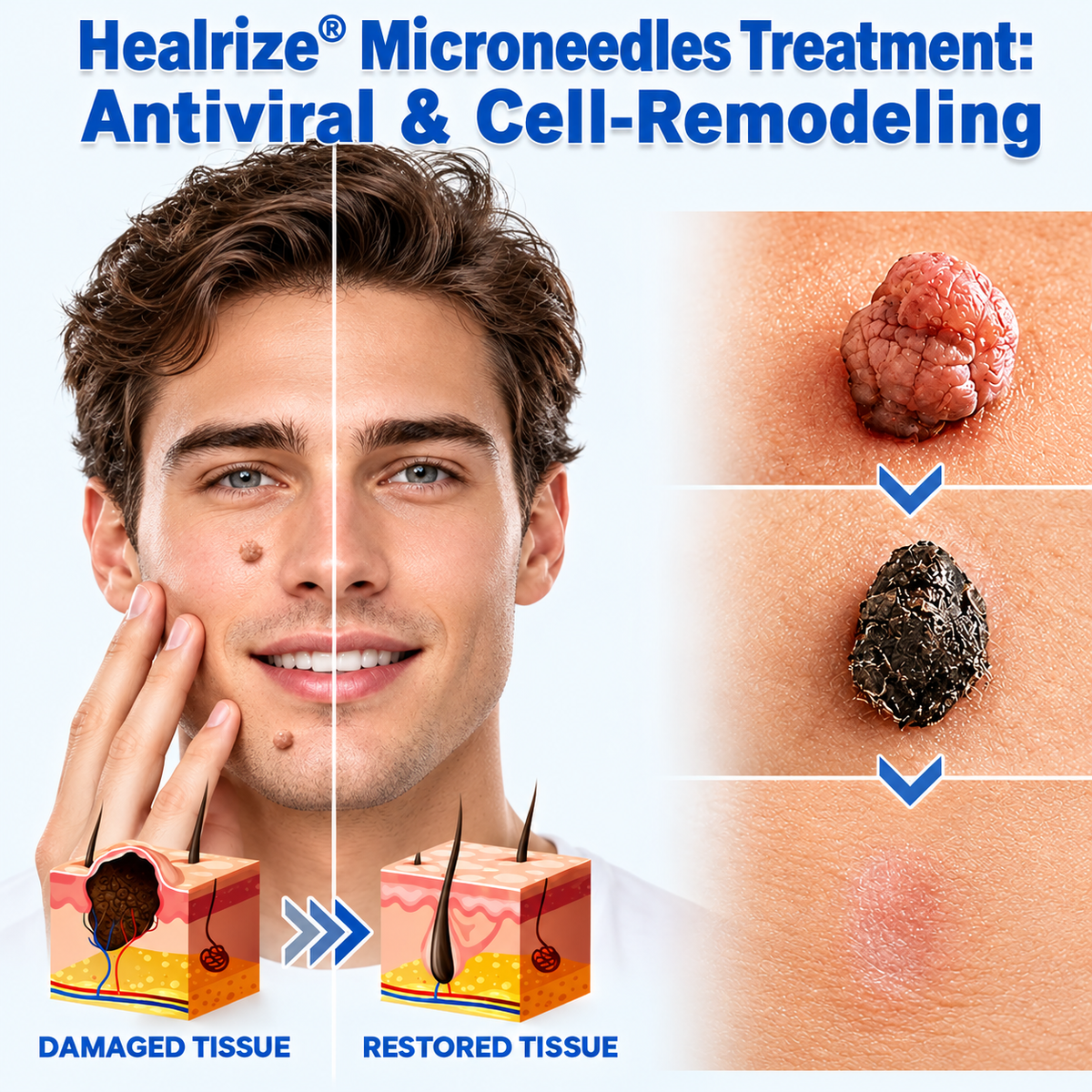 💦💦 𝐎𝐟𝐟𝐢𝐜𝐢𝐚𝐥 𝐒𝐭𝐨𝐫𝐞 |  Healrize®  👩‍⚕️𝐁𝐨𝐭𝐚𝐧𝐢𝐜𝐚𝐥 𝐌𝐢𝐜𝐫𝐨𝐧𝐞𝐞𝐝𝐥𝐞 𝐇𝐲𝐝𝐫𝐨𝐜𝐨𝐥𝐥𝐨𝐢𝐝 𝐏𝐚𝐭𝐜𝐡 (𝐅𝐨𝐫 𝐒𝐤𝐢𝐧 𝐓𝐚𝐠𝐬, 𝐒𝐦𝐚𝐥𝐥 𝐒𝐤𝐢𝐧 𝐆𝐫𝐨𝐰𝐭𝐡𝐬, 𝐖𝐚𝐫𝐭𝐬, 𝐌𝐨𝐥𝐞𝐬, 𝐀𝐠𝐞 𝐒𝐩𝐨𝐭𝐬 & 𝐏𝐢𝐠𝐦𝐞𝐧𝐭𝐚𝐭𝐢𝐨𝐧 𝐂𝐨𝐧𝐜𝐞𝐫𝐧𝐬)